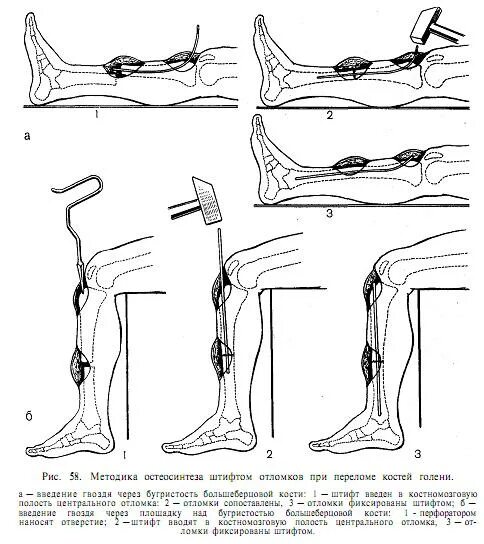 Переломы (для ускорения консолидации костных отломков);. Интрамедуллярный остеосинтез большеберцовой кости. Экстрамедуллярный остеосинтез голени. Разрабатываем ногу после операции
