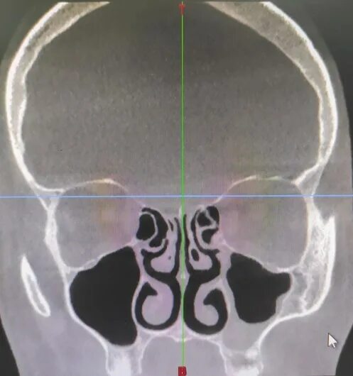 Сфеноидит операция. Сфеноидит на кт. Соустье гайморовой пазухи. Левосторонний сфеноидит на кт. Клиновидная пазуха и сфеноидит.