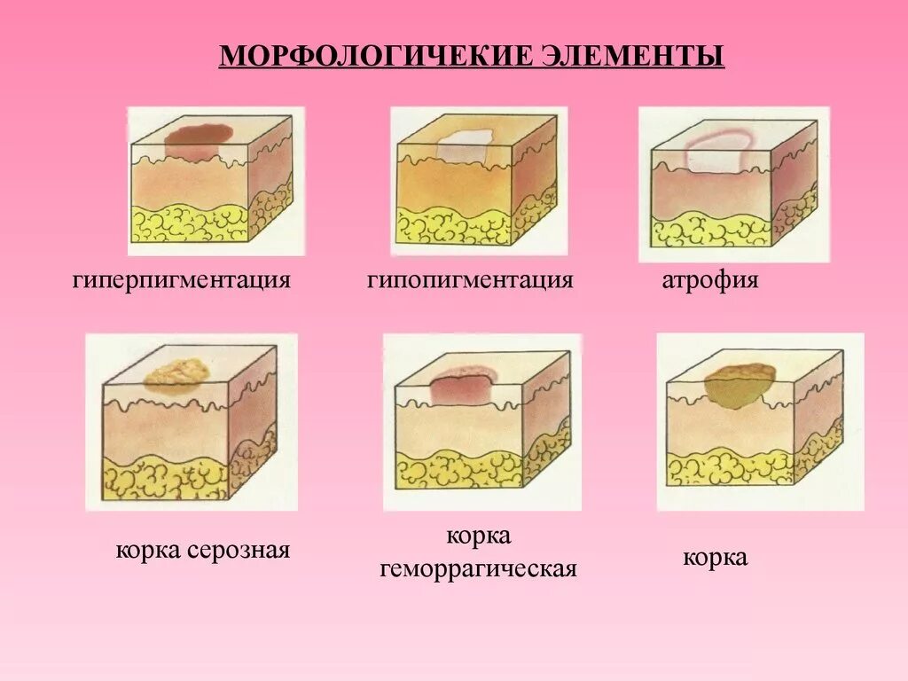 Вторичные элементы поражения. Вторичные морфологические элементы кожных высыпаний. Вторичные морфологические элементы кожи корка. Вторичные морфологические элементы кожи гиперпигментация. Первичные морфологические элементы кожи экскориация.