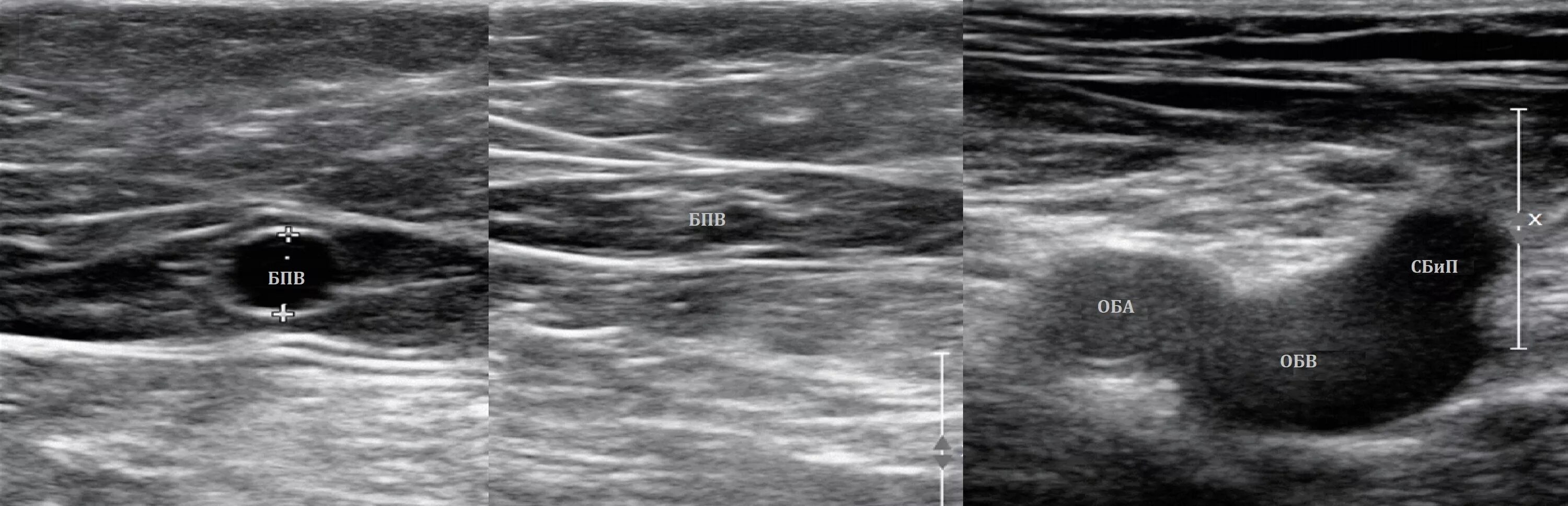 Тромбоз бпв. Тромбоз общей бедренной вены УЗИ. Тромбоз артерий нижних конечностей на УЗИ.