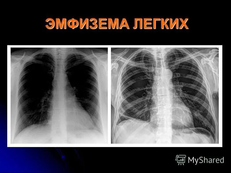 Эмфизема изменения. Торакогенная эмфизема. эмфизема лёгких на рентгенограмме. буллезная эмфизема рентген. хобл диффузная эмфизема.
