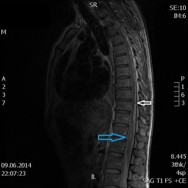 Рак поясницы. Интрамедуллярная опухоль спинного мозга мрт. Липома позвоночного канала мрт. Опухоль позвоночника мрт. Опухоли позвоночника и спинного мозга.
