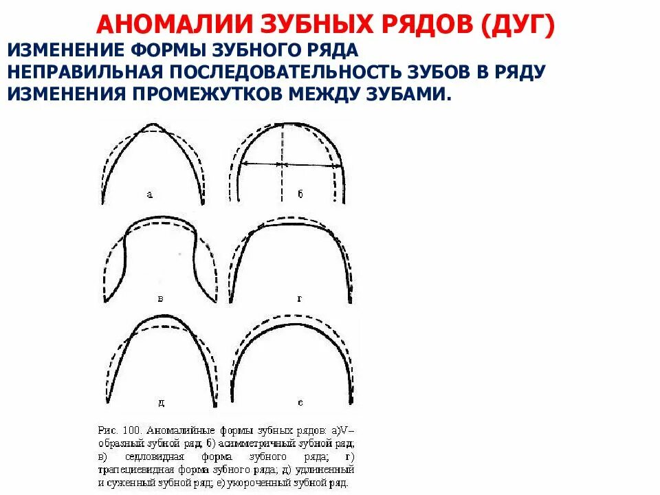 Изменение ряда. Классификация аномалий формы зубных рядов. Зубная дуга параболической формы. Формы зубных дуг верхней и нижней челюсти. Форма дуги верхней челюсти.
