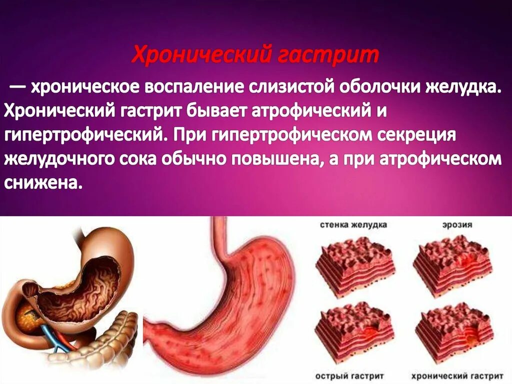 Заболевания желудка человека. Хронический гастрит и язвенная болезнь. Острый гастрит – это заболевание слизистой оболочки желудка. Острые и хронические заболевания ЖКТ. Язвенная болезнь желудка и двенадцатиперстной Кишк.