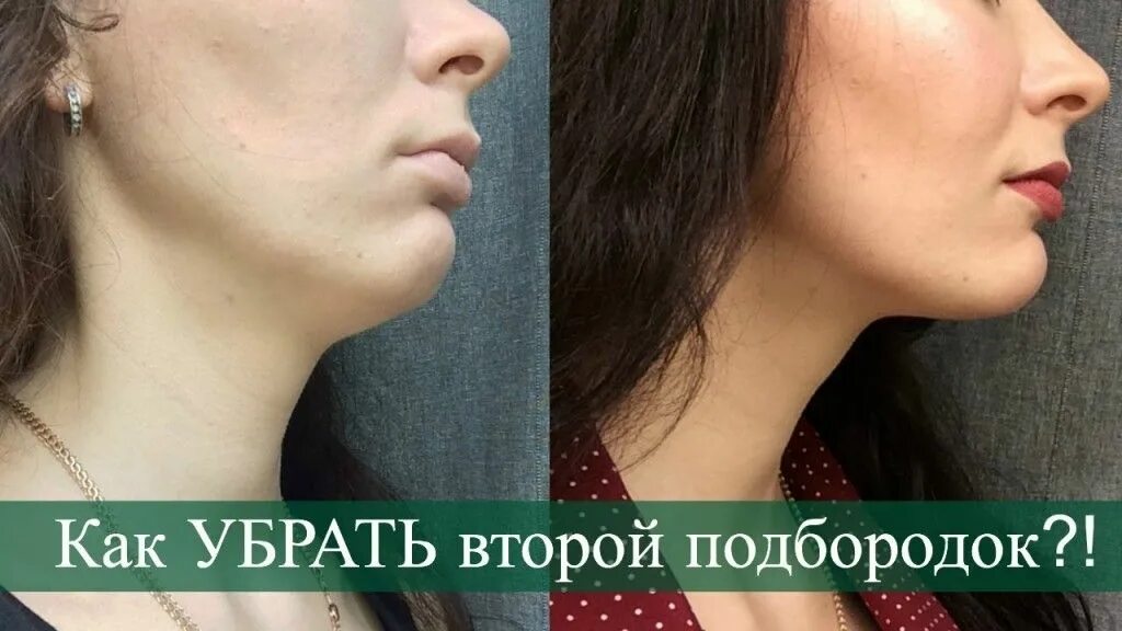Чтобы не было подбородка. Второй подбородок. убрать второй подбородок. подбородок до и после. женщина без подбородка.