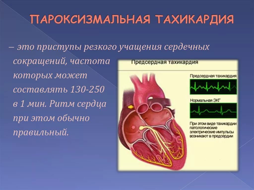 Тахикардия. Приступ тахикардии. Приступ пароксизмальной тахикардии. Сердечные заболевания тахикардия.