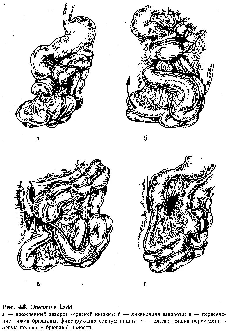 Симптомы операция кишечнике. Заворот непроходимости кишечника. Заворот кишок (инвагинация). Кишечная непроходимость заворот. Заворот кишок непроходимость кишечника.