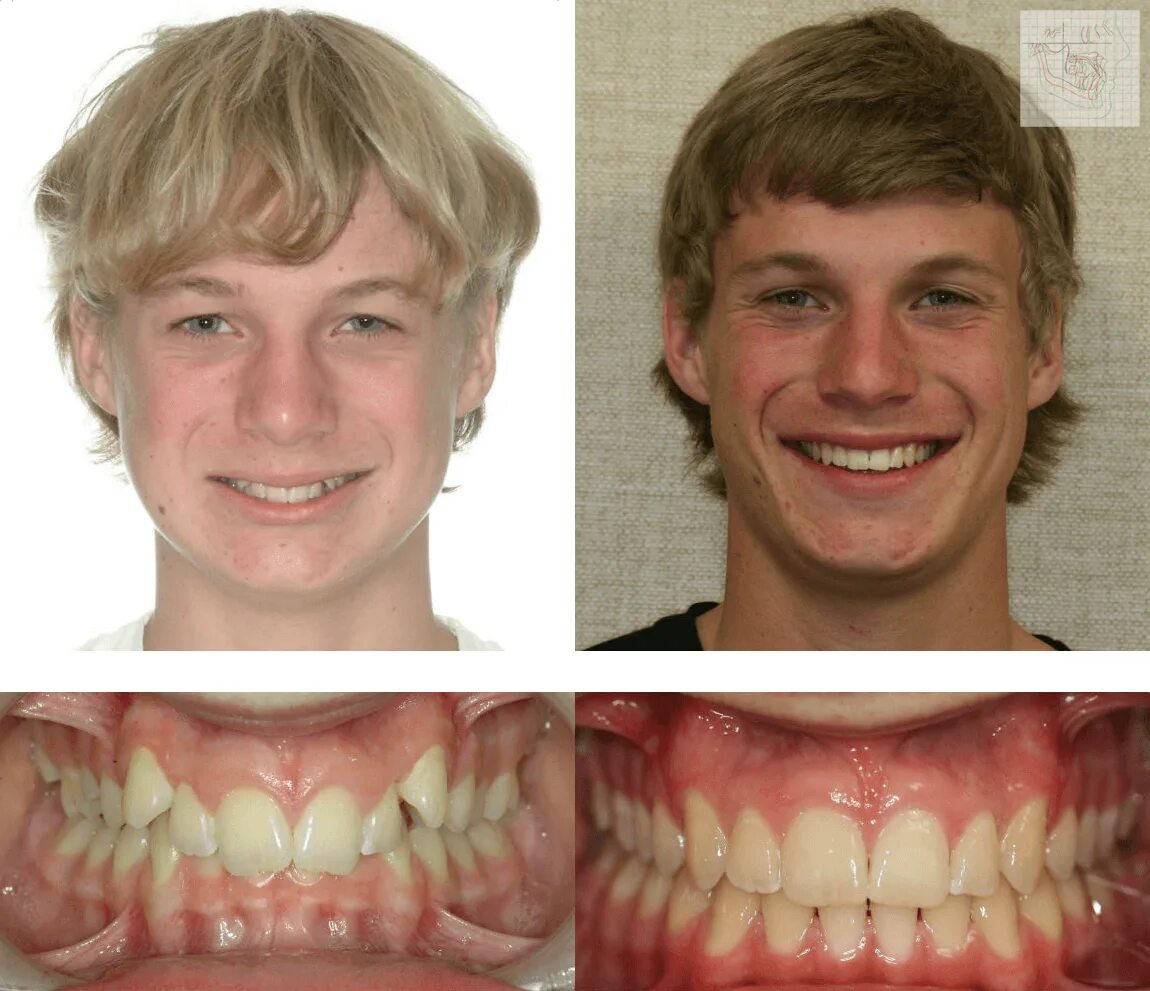 Изменение прикуса элайнерами. Частичная брекет-система damon 2 на 4. Исправление зубов брекетами. Дистальный прикус твинблок. Исправление 14.