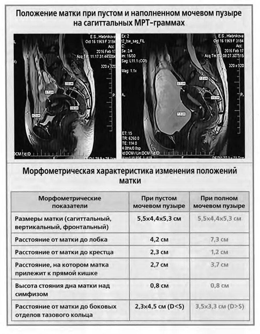 Расположение матки и мочевого пузыря. Положение матки. Органы малого таза у женщин схема. Анатомия органов малого таза у женщин.