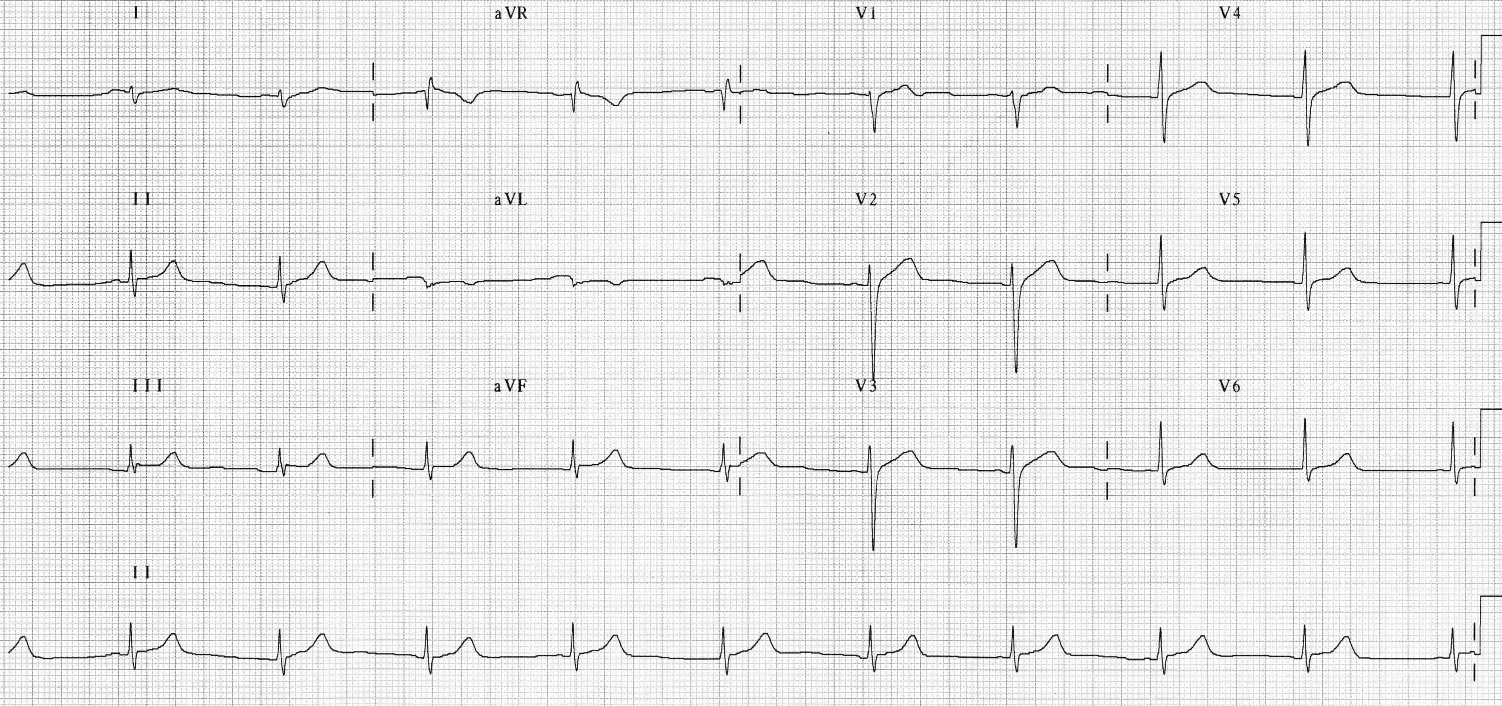 Ишемия боковой стенки. Ишемия миокарда на ЭКГ. Инфаркт миокарда предсердий на ЭКГ. Нестабильная стенокардия ЭКГ. ЭКГ при стенокардии и инфаркте миокарда.