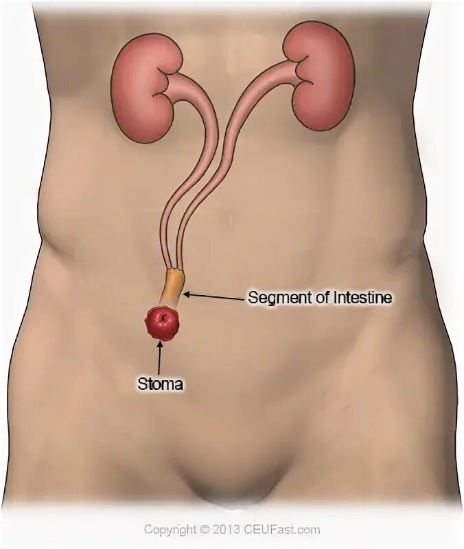 Стомы мочевыделительной системы.