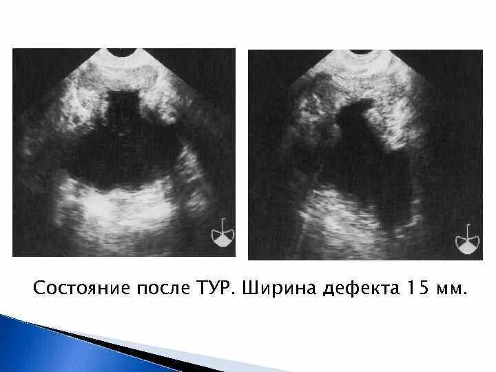 УЗИ после тур предстательной железы. Простата после тур на УЗИ. УЗИ картина предстательной железы. Состояние после тур на УЗИ.