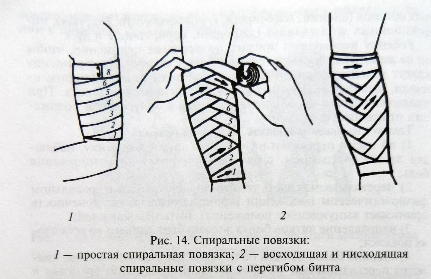 Спиральная повязка алгоритм. Колосовидная повязка показания. Колосовидная повязка на конечность. Технология наложения спиральной повязки. Техника наложения спиральной повязки на предплечье.