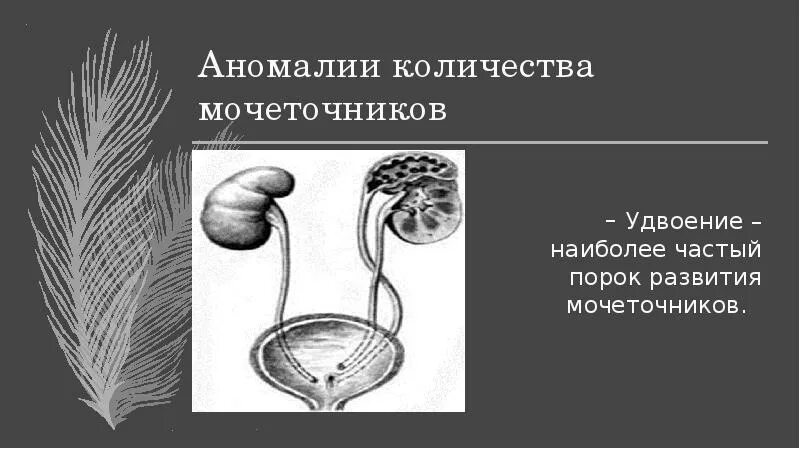 Удвоение мочеточника. Аномалии развития мочеточников. Удвоение мочеточника пороки развития. Аномалии мочеточников классификация. Удвоение почки удвоение мочеточника.