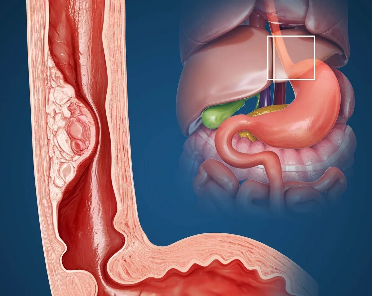 Пищевод открывается в желудок. Злокачественные новообразования пищевода. Плоскоклеточная папиллома пищевода. Эзофагит пищевода язвенный.