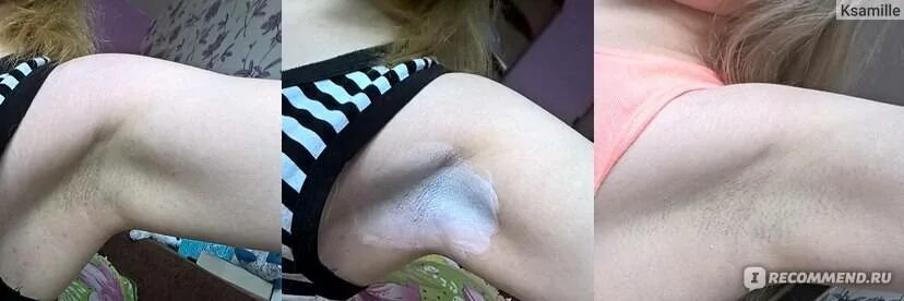 Темная зона подмышек. Темные волосы на подмышках. Потемнение кожи подмышек. Темная зона подмышек. Потемнела кожа подмышками.