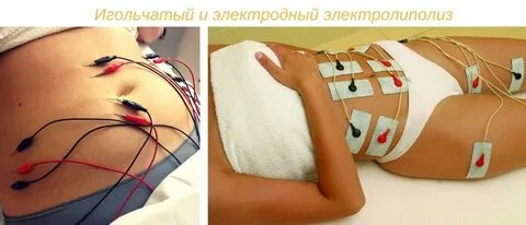 Электролиполиз отзывы