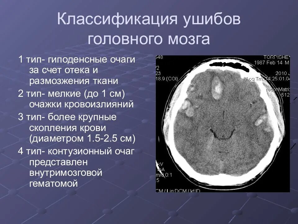 Травма мозга очаговая. Очаги ушиба головного мозга на кт. Контузионный очаг мозга кт. Контузионные очаги головного мозга классификация. Контузионный очаг 1 типа на кт.