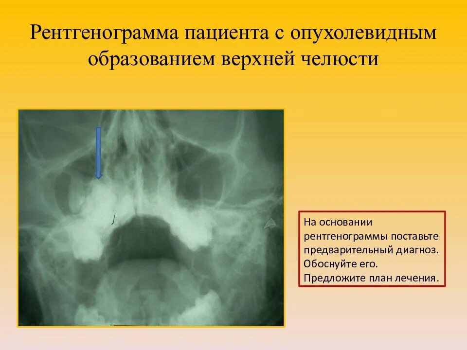 Доброкачественные опухоли у детей. Опухоли челюстно-лицевой области. Рентгенограмма верхней челюсти. Новообразования челюстно-лицевой области. Рентгенограммы опухоль верхней челюсти.