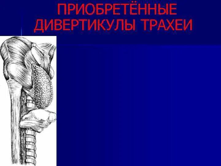 Дивертикул трахеи. Дивертикул главного бронха. дивертикулы трахеи и бронхов.