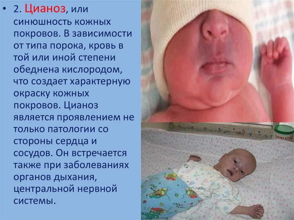 Центральный цианоз. Врожденные пороки сердца с цианозом. Цианоз при врожденных пороках сердца у детей. Цианоз кожных покровов у ребенка. Диффузный цианоз кожных покровов.