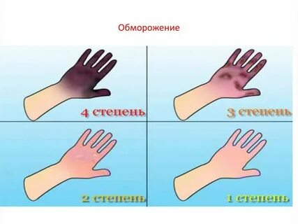 Отморожению чаще всего подвергаются