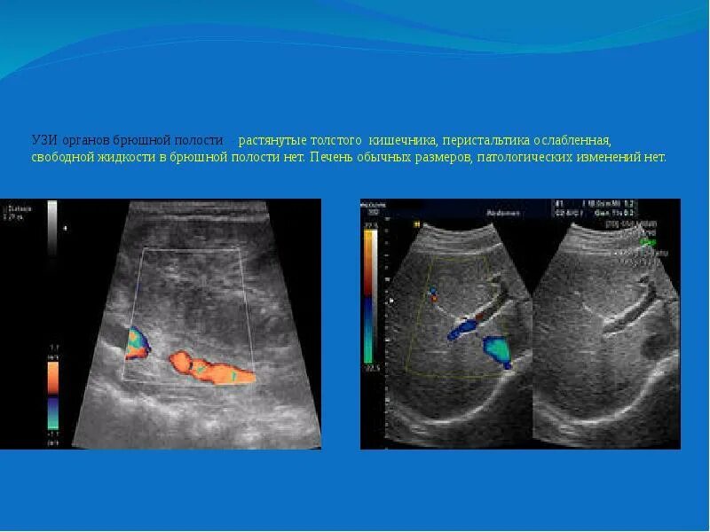 УЗИ брюшной полости. Ультразвуковое исследование органов брюшной полости (УЗИ). УЗИ органов брюшной полос. Абдоминальное УЗИ брюшной полости. Узи кишечника как подготовиться