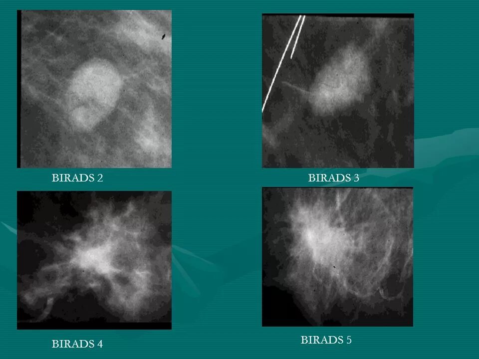Маммография bi-rads 2. Bi-rads 3 молочной железы маммограмма. Классификация bi-rads молочных желез. Фиброзно кистозная мастопатия молочной железы bi-rads-4a. Категории маммографии