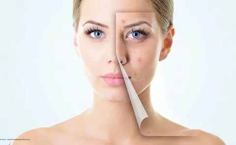 Acne removing