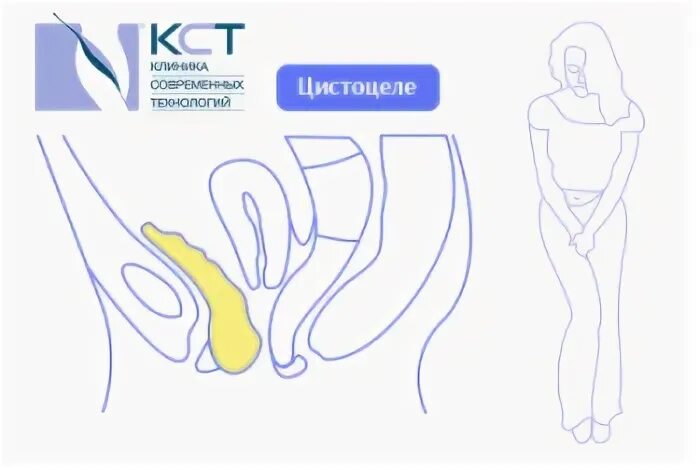Пролапс тазовых органов у женщин что такое. Признаки опущения органов малого таза у женщин. выпадение органов малого таза. опущение органов малого таза у женщин симптомы.