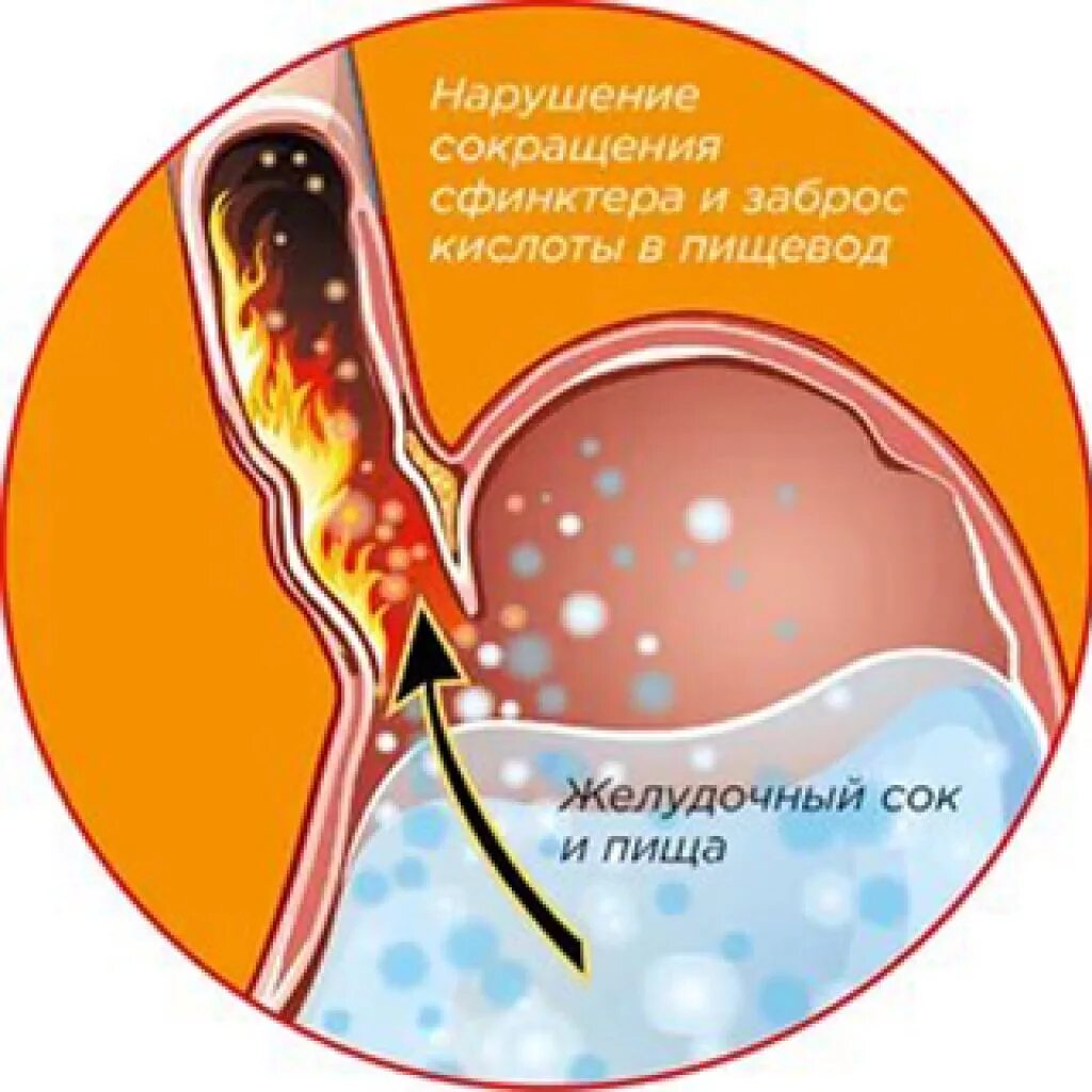 Заброс желудочного сока в пищевод. Заброс кислоты в пищевод. От заброса кислоты в пищевод. Забрасывание желудочного сока в пищевод. Почему бывает жжение