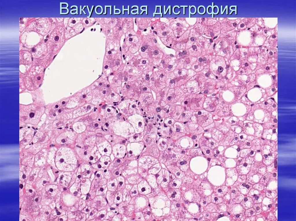 Гидропическая дистрофия печени. Гидропическая белковая дистрофия. Гиалиново капельная дистрофия печени гистология. Гидропическая и баллонная дистрофия.