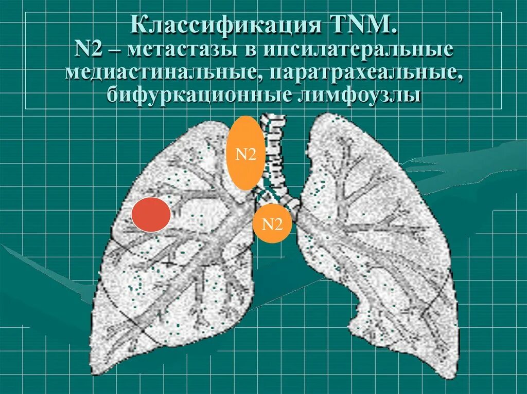 Метастазы в легких лимфоузлы. Ипсилатеральное легкое. Медиастинальные узлы. Ипсилатеральный лимфоузел это. Ипсилатеральной лимфодиссекцией.