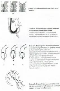 Колоноскопия подвздошной кишки
