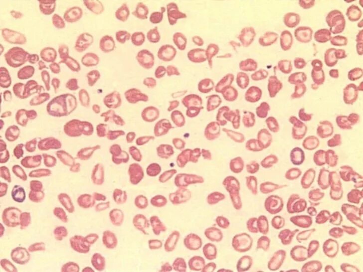 Пойкилоцитоз анемия. Гипохромия эритроцитов, пойкилоцитоз.. Железодефицитная анемия пойкилоцитоз. Пойкилоцитоз при жда. Анизоцитоз пойкилоцитоз гипохромия, тельца Джоли.