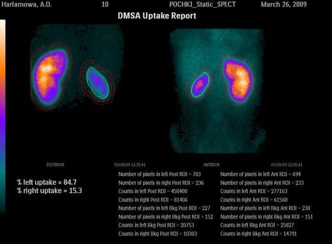 Исследование изотопами. Радиоизотопное исследование почек при гломерулонефрите. Сцинтиграфия почек пиелонефрит динамическая. Радионуклидные методы исследования почек. Статическая сцинтиграфия почек норма.