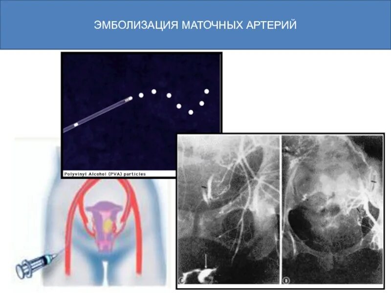 Эма миомы матки. Эмболизация маточных сосудов. эмболизация маточных артерий эма. эмболизация ветвей маточных артерий. эмболизация маточных труб.