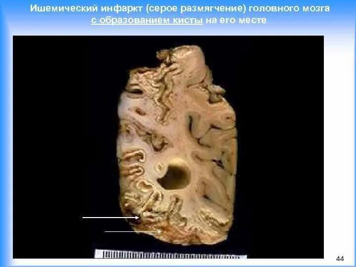 Размягчение головного мозга. Ишемический инфаркт головного мозга патанатомия. Ишемический инфаркт головного мозга макропрепарат. Киста головного мозга патанатомия. Очаг серого размягчения головного мозга.