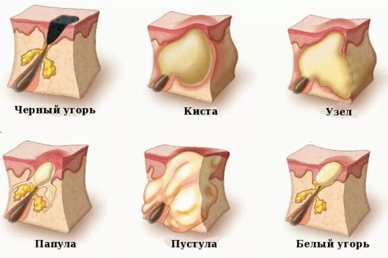 Папуло-пустулезные угри. Папула пустула узел киста. Акне комедон папула пустула.