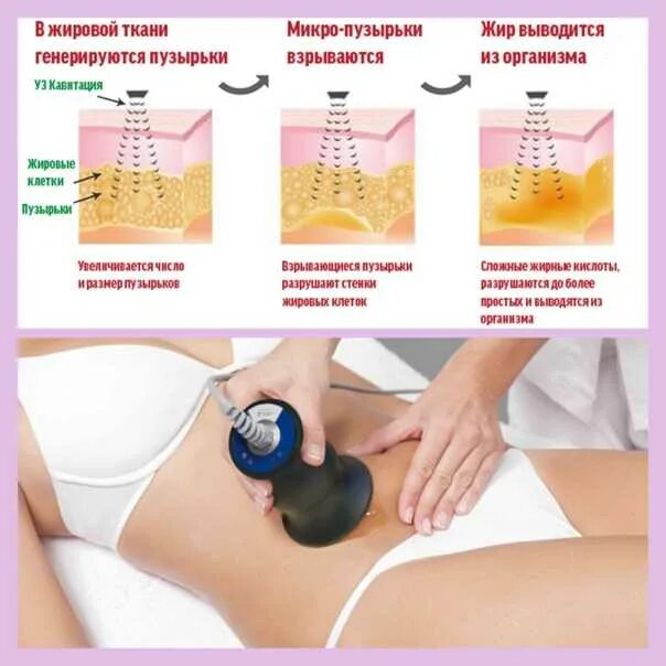 Ультразвуковая кавитация схема. Уз кавитация вакуумный массаж. Ультразвук жир. Ультразвуковая кавитация принцип действия. Аппарат липолиз кавитация rf.