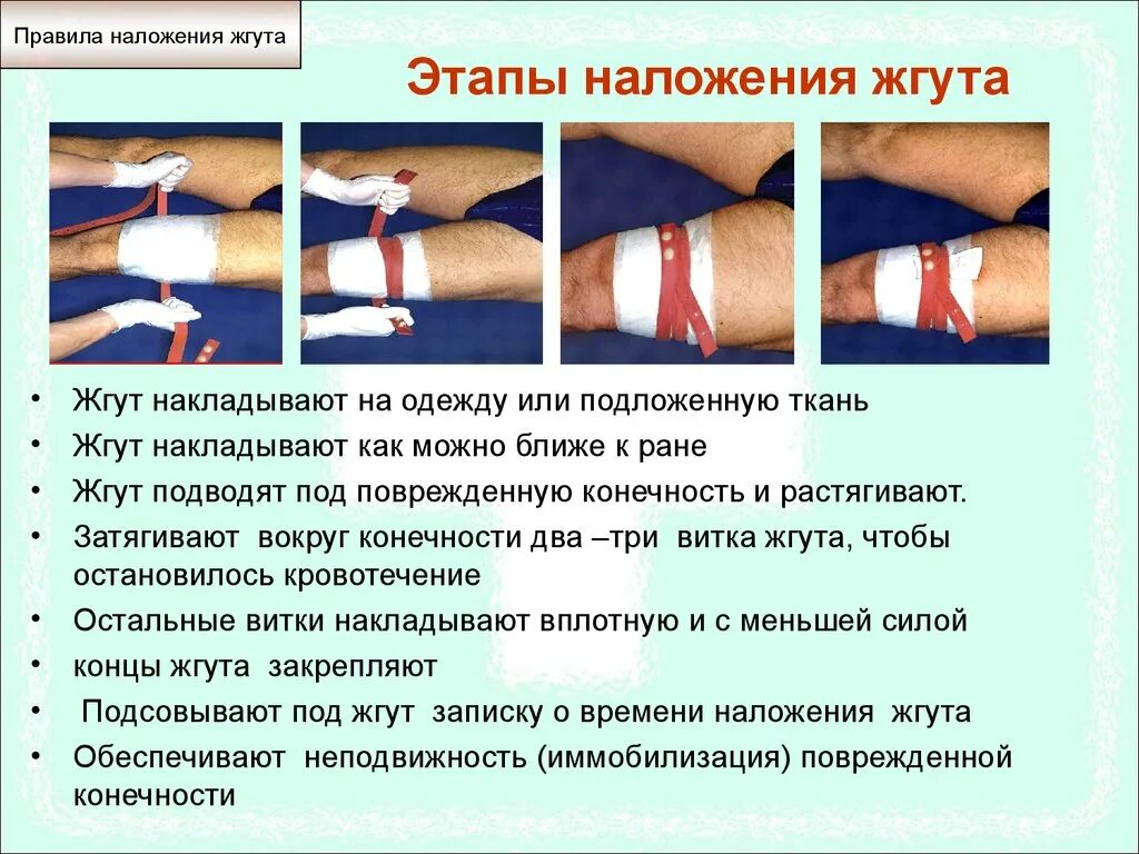 Жгут можно накладывать при кровотечении. Техника наложения артериального жгута при артериальном кровотечении. При правильном наложении жгута для остановки кровотечения:. Расскажите порядок наложения жгута.. Правила наложения артериального кровоостанавливающего жгута.