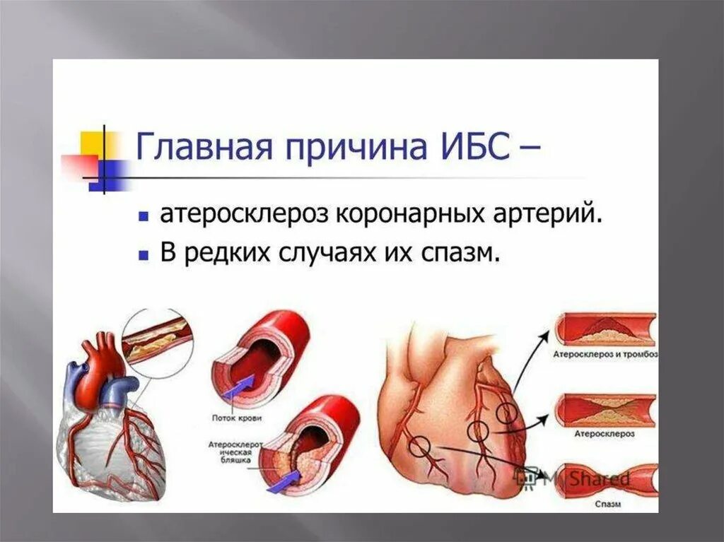 Ишемия передней стенки. ИБС стенокардия атеросклероз симптомы. ИБС атеросклероз коронарных артерий. ИБС атеросклеротическая болезнь сердца. Причины развития ишемической болезни сердца.