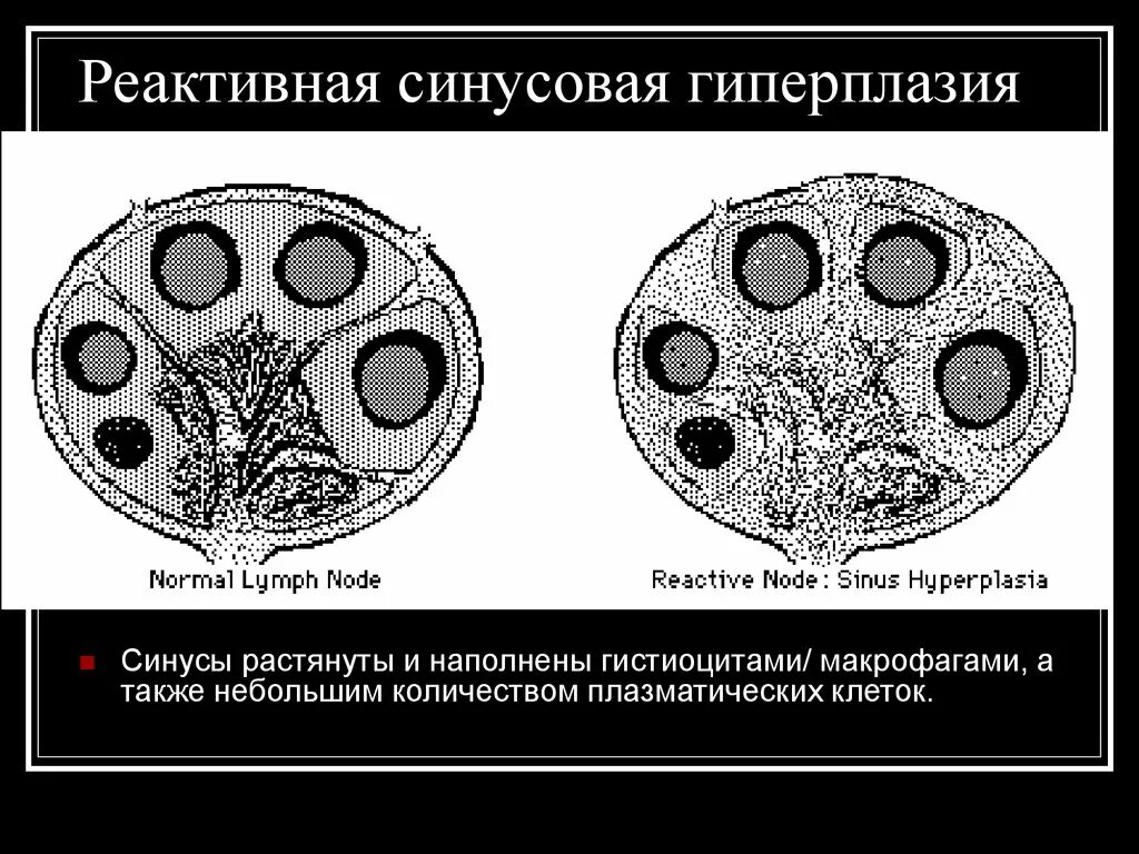 Лимфоузел реактивная гиперплазия. Лимфоузлы с реактивной гиперплазией. Гиперплазия схематическое изображение. Гиперплазия клеток рисунок-схема. Реактивная гиперплазия лимфоузла