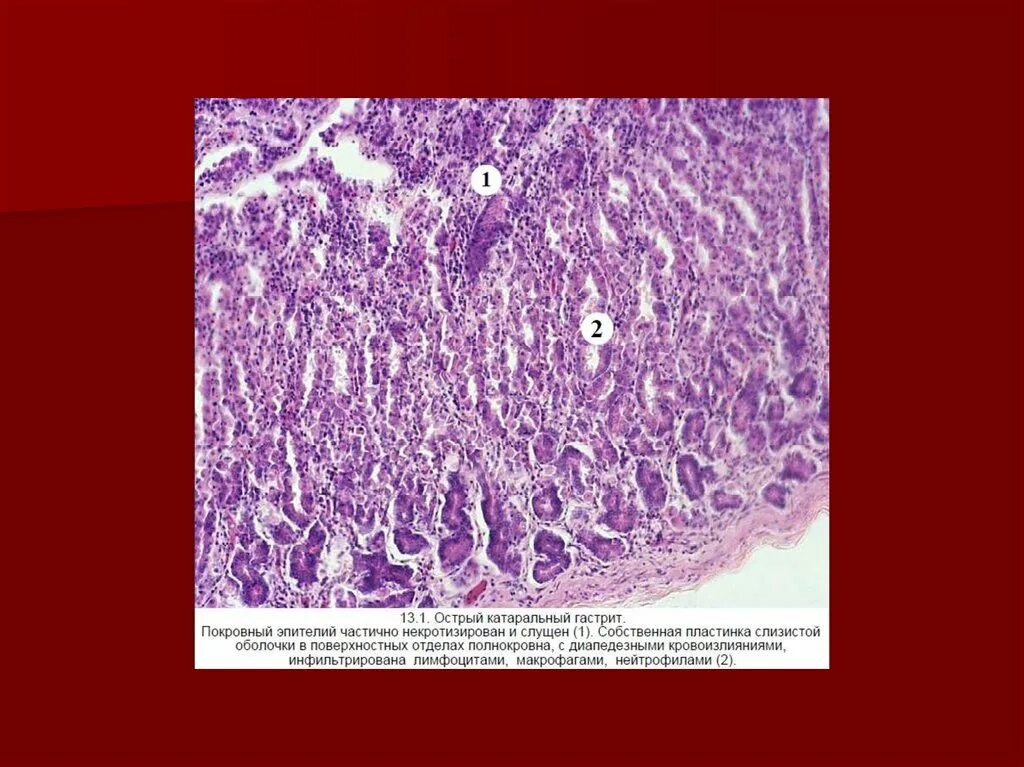 Воспаление серозной оболочки. Острый гастрит микропрепарат. Катаральный серозный гастрит. Макропрепарат. Фибринозный гастрит патологическая анатомия. Катаральный гастрит микропрепарат.