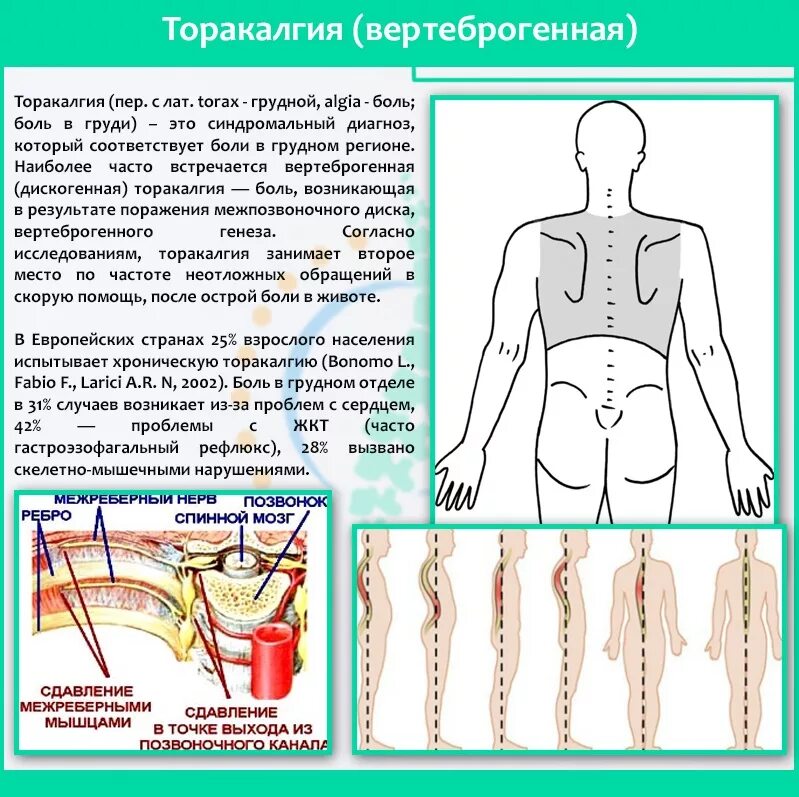 Остеохондроз локальный статус. Вертиброгенная торкалия. Верте.рогенная тораклагия. Вертеброгенная торакалгия. Торакалгия грудного отдела.