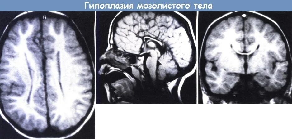 Внутриутробное недоразвитие головного мозга. Дисплазия мозолистого тела головного мозга кт. Агенезия валика мозолистого тела мрт. Агенезия мозолистого тела дети. Агенезия прозрачной перегородки головного мозга мрт.