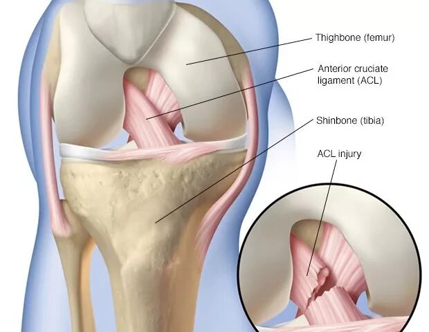 Anterior cruciate ligament Reconstruction. Разрыв передней крестообразной связки. Передняя крестообразная связка. Пластика передней крестообразной связки коленного сустава.