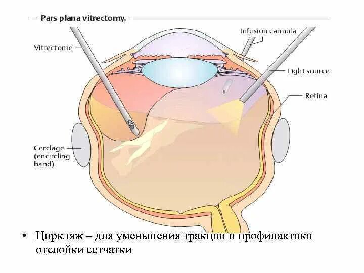 Циркляж. Циркляж сетчатки глаза. экстрасклеральное пломбирование сетчатки. отслойка сетчатки циркляж. пломбирование отслойки сетчатки.