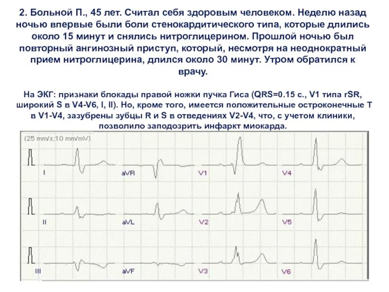 Миокард программа. Диффузные изменения миокарда на экг. экг диффузные неспецифические изменения в миокарде. экг при диффузных изменениях миокарда. умеренные диффузные изменения на экг у взрослого.