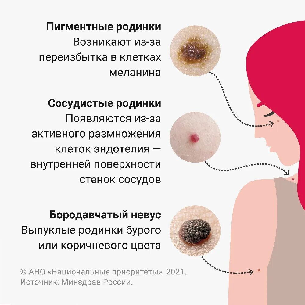 Как выглядит невус на коже человека Удаление папиллом, акция! Медицинская Клиника "Медина" в Раменском, Жуковском